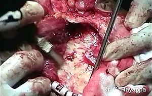 Craniofacial resection cystic carcinoma
