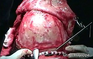 Craniofacial resection cystic carcinoma