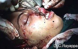 Midfacial split surgery young woman