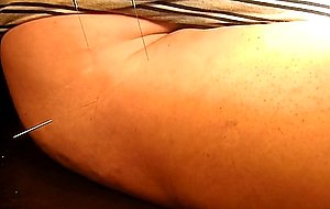 Acupuncture 2  
