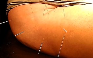 Acupuncture 2  