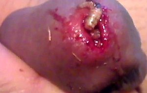 Maggot in pee hole